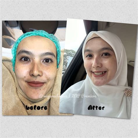 10 Perawatan ZAP Terbaik and Harganya yang Bikin Kantong Gak Bolong! 10 Perawatan ZAP Terbaik and Harganya yang Bikin Kantong Gak Bolong!