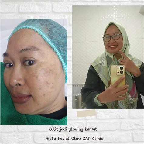 10 Perawatan ZAP Terbaik and Harganya yang Bikin Kantong Gak Bolong! 10 Perawatan ZAP Terbaik and Harganya yang Bikin Kantong Gak Bolong!