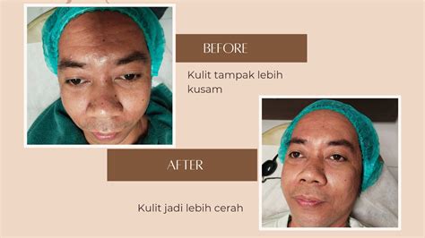 10 Perawatan ZAP Terbaik and Harganya yang Bikin Kantong Gak Bolong! 10 Perawatan ZAP Terbaik and Harganya yang Bikin Kantong Gak Bolong!