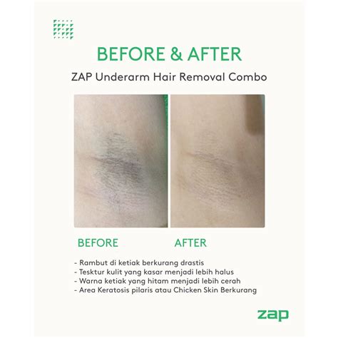 10 Perawatan ZAP Terbaik and Harganya yang Bikin Kantong Gak Bolong! 10 Perawatan ZAP Terbaik and Harganya yang Bikin Kantong Gak Bolong!