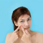5 Cara Ampuh Hempaskan Jerawat di Dahi dalam 7 Hari!