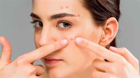 5 Cara Ampuh Hempaskan Jerawat di Dahi dalam 7 Hari! 5 Cara Ampuh Hempaskan Jerawat di Dahi dalam 7 Hari!