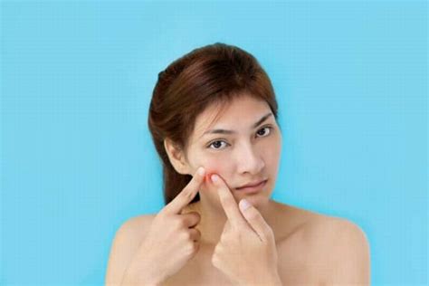 5 Cara Ampuh Hempaskan Jerawat di Dahi dalam 7 Hari!