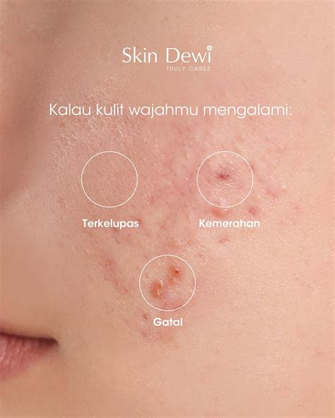 5 Cara Simpel Bikin Kulit Keringmu Lembap Bak Bayi!