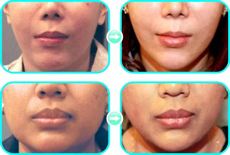5 Fakta Harga Facial di Benings Clinic: Mulai RpXXX, Worth It Gak? 5 Fakta Harga Facial di Benings Clinic: Mulai RpXXX, Worth It Gak?