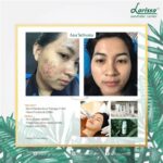 5 Perawatan Larissa Harga di Bawah 100 Ribu: Glowing Tanpa Bikin Kantong Bolong!