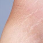 5 Rahasia Alami Hilangkan Stretch Mark Dalam 2 Minggu!