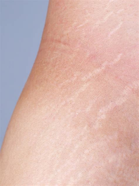 5 Rahasia Alami Hilangkan Stretch Mark Dalam 2 Minggu!