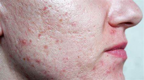5 Rahasia Perawatan Wajah Dermapen Glowing Dalam 7 Hari! 5 Rahasia Perawatan Wajah Dermapen Glowing Dalam 7 Hari!