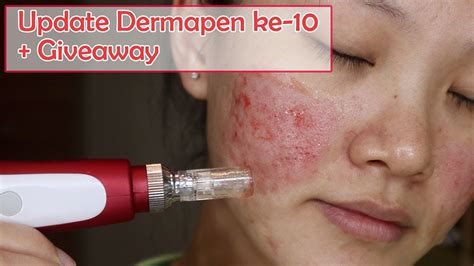 5 Rahasia Perawatan Wajah Dermapen Glowing Dalam 7 Hari! 5 Rahasia Perawatan Wajah Dermapen Glowing Dalam 7 Hari!