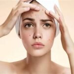5 Rekomendasi Biaya Treatment Wajah Berjerawat, Mulai dari Rp50.000!