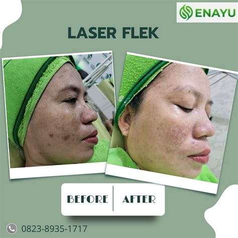 5 Rekomendasi Biaya Treatment Wajah Berjerawat, Mulai dari Rp50.000! 5 Rekomendasi Biaya Treatment Wajah Berjerawat, Mulai dari Rp50.000!