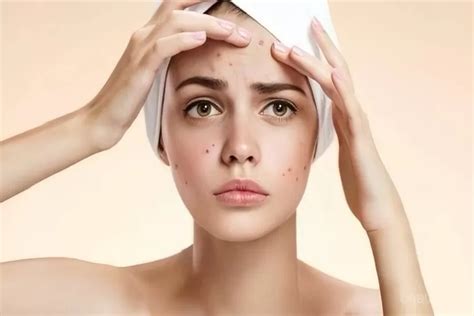 5 Rekomendasi Biaya Treatment Wajah Berjerawat, Mulai dari Rp50.000!