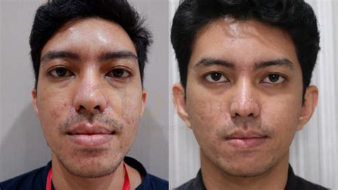 5 Tarif Laser Wajah Paling Murah 2024: Wajah Glowing Mulai dari Rp99 Ribu! 5 Tarif Laser Wajah Paling Murah 2024: Wajah Glowing Mulai dari Rp99 Ribu!