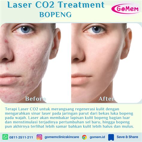5 Tarif Laser Wajah Paling Murah 2024: Wajah Glowing Mulai dari Rp99 Ribu! 5 Tarif Laser Wajah Paling Murah 2024: Wajah Glowing Mulai dari Rp99 Ribu!