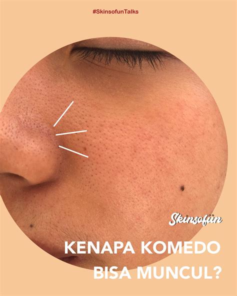 5 Tips Mudah Hilangkan Komedo Tak Pernah Kembali! 5 Tips Mudah Hilangkan Komedo Tak Pernah Kembali!