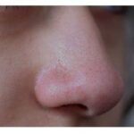 5 Tips Mudah Hilangkan Komedo Tak Pernah Kembali!