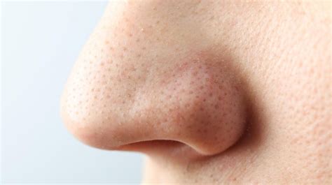 5 Tips Mudah Hilangkan Komedo Tak Pernah Kembali! 5 Tips Mudah Hilangkan Komedo Tak Pernah Kembali!