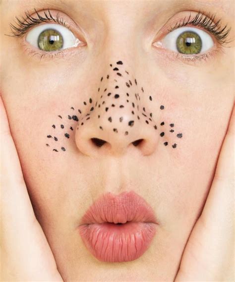 5 Treatment Hilangkan Komedo yang Bikin Kulit Kinclong dalam Seminggu! 5 Treatment Hilangkan Komedo yang Bikin Kulit Kinclong dalam Seminggu!