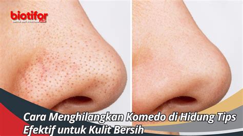 5 Treatment Hilangkan Komedo yang Bikin Kulit Kinclong dalam Seminggu! 5 Treatment Hilangkan Komedo yang Bikin Kulit Kinclong dalam Seminggu!