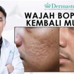 5 Treatment Wajah Bopeng Merawat Kulit Impian, Mulai Rp100.000! 😱
