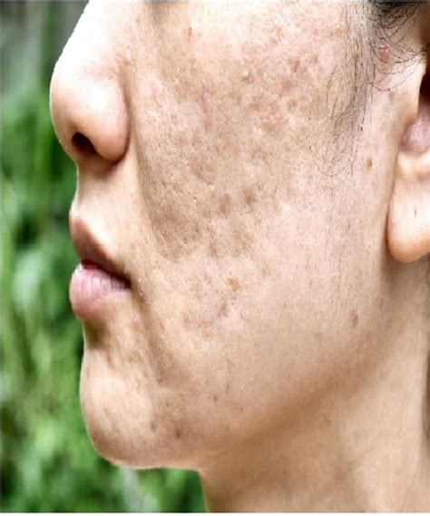 5 Treatment Wajah Bopeng Merawat Kulit Impian, Mulai Rp100.000! 😱