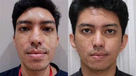 5 Treatment Wajah Bopeng Merawat Kulit Impian, Mulai Rp100.000! 😱