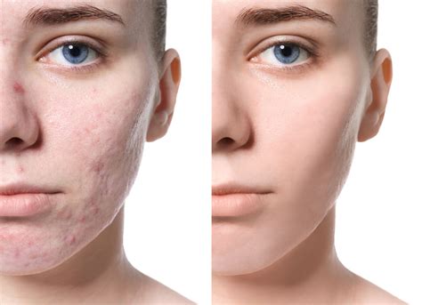 5 Treatment Wajah Bopeng Merawat Kulit Impian, Mulai Rp100.000! 😱