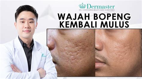 5 Treatment Wajah Bopeng Merawat Kulit Impian, Mulai Rp100.000! 😱