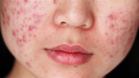 7 Cara Ampuh Basmi Jerawat and Minyak di Wajah! 7 Cara Ampuh Basmi Jerawat and Minyak di Wajah!