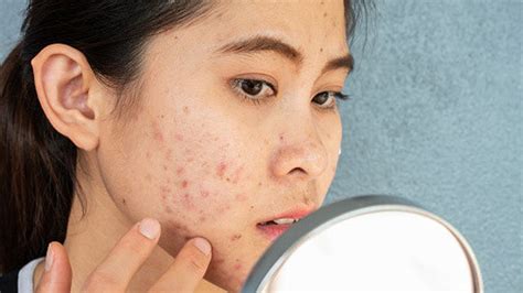 7 Cara Ampuh Menghilangkan Jerawat dan Minyak Berlebih pada Kulit dalam 1 Minggu! 7 Cara Ampuh Menghilangkan Jerawat dan Minyak Berlebih pada Kulit dalam 1 Minggu!