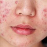 7 Langkah Wajib Perawatan Wajah Berjerawat Sebelum Tidur, Bye Jerawat Membandel!