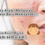 7 Rahasia Alami Usir Jerawat Membandel!