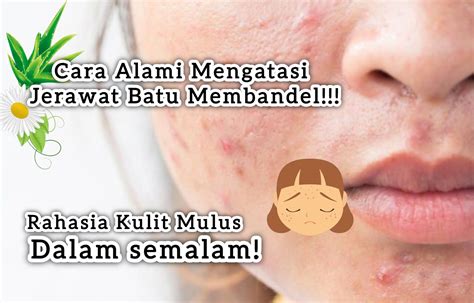 7 Rahasia Alami Usir Jerawat Membandel!