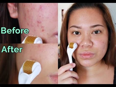 7 Rahasia Skincare Setelah Dermaroller Biar Wajah Kinclong Maksimal! 7 Rahasia Skincare Setelah Dermaroller Biar Wajah Kinclong Maksimal!