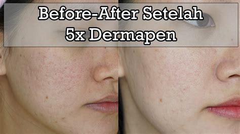 7 Rahasia Skincare Setelah Dermaroller Biar Wajah Kinclong Maksimal! 7 Rahasia Skincare Setelah Dermaroller Biar Wajah Kinclong Maksimal!