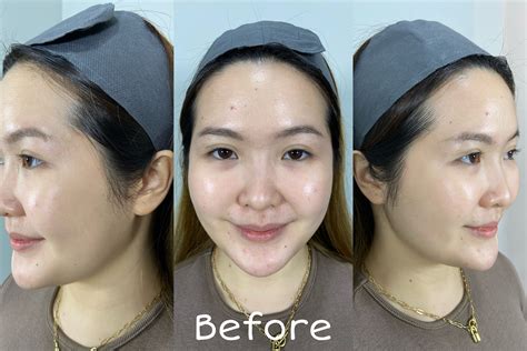 7 Treatment Dermies di Bawah 500 Ribu: Bye-Bye Kusam, Halo Glowing!