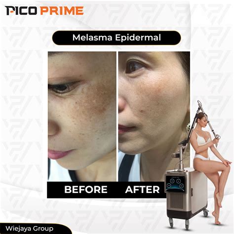 Pico Laser: 5 Fakta Harga and 3 Cara Hematnya Wajib Kamu Tahu! Pico Laser: 5 Fakta Harga and 3 Cara Hematnya Wajib Kamu Tahu!