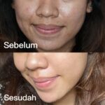 7 Treatment Jerawat Membandel di Bawah 500 Ribu, Dijamin Ampuh!