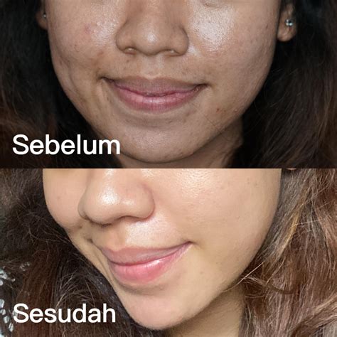 7 Treatment Jerawat Membandel di Bawah 500 Ribu, Dijamin Ampuh!