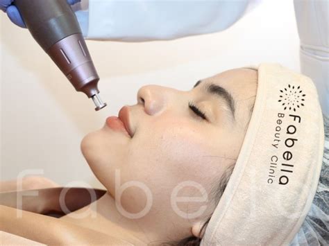 7 Treatment Ampuh Basmi Komedo Membandel, Nomor 5 Bikin Kaget!