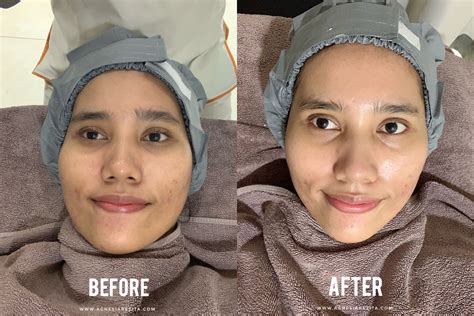 7 Treatment Facial Terlaris di ERHA and Harganya di 2024! Nomor 5 Bikin Kaget!