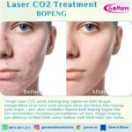 7 Treatment Wajah Bopeng Mulai 200 Ribuan: Bye-bye Kawah, Halo Mulus!