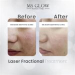 5 Alasan Harga Laser Wajah MS Glow Lebih Murah dari yang Kamu Kira!