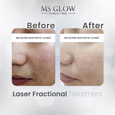 5 Alasan Harga Laser Wajah MS Glow Lebih Murah dari yang Kamu Kira! 5 Alasan Harga Laser Wajah MS Glow Lebih Murah dari yang Kamu Kira!