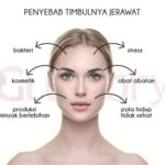 5 Cara Jitu Merawat Wajah Berjerawat dan Berminyak: Kulit Glowing Bebas Kilap!