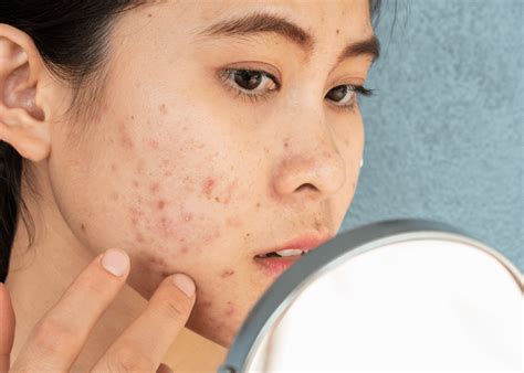 5 Cara Jitu Merawat Wajah Berjerawat dan Berminyak: Kulit Glowing Bebas Kilap! 5 Cara Jitu Merawat Wajah Berjerawat dan Berminyak: Kulit Glowing Bebas Kilap!
