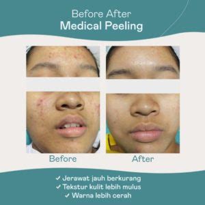 5 Harga Perawatan Athena yang Bikin Kantong Gak Jebol (Plus Bonus!) 5 Harga Perawatan Athena yang Bikin Kantong Gak Jebol (Plus Bonus!)