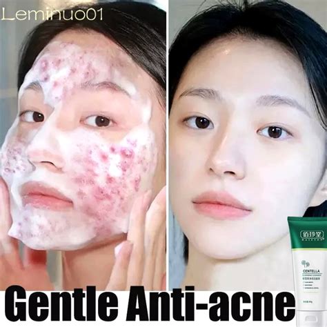 5 Pemutih Wajah Ampuh Atasi Jerawat: Kulit Glowing Bebas Kilap! 5 Pemutih Wajah Ampuh Atasi Jerawat: Kulit Glowing Bebas Kilap!