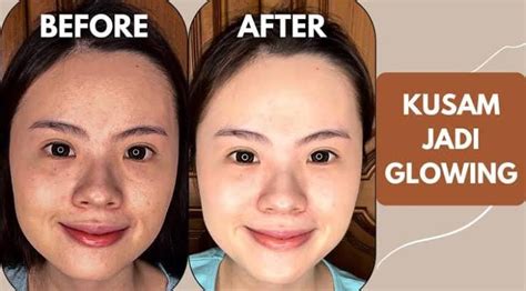 5 Pemutih Wajah Ampuh Atasi Jerawat: Kulit Glowing Bebas Kilap!
